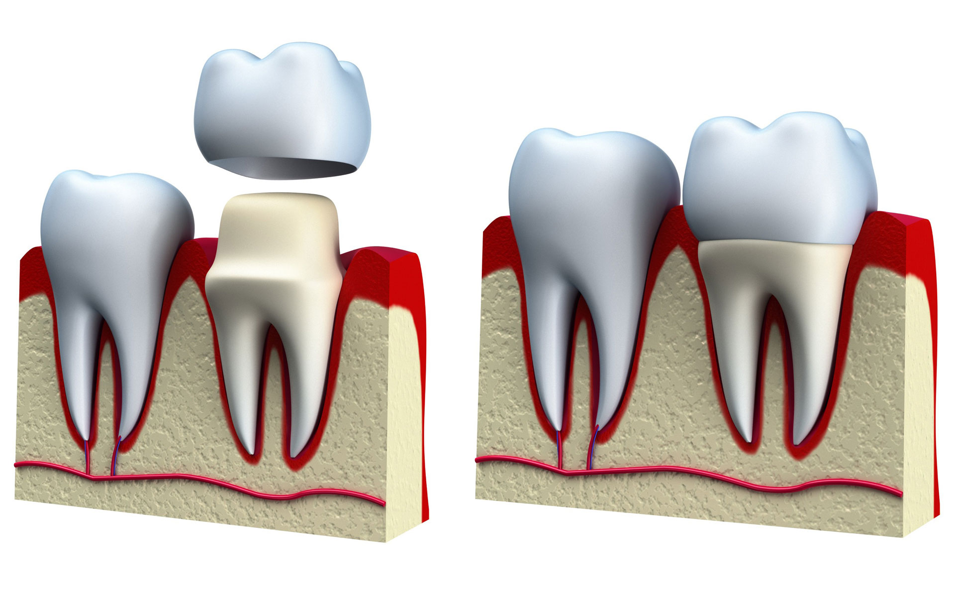 Dental Crown - Your Chino Dentist