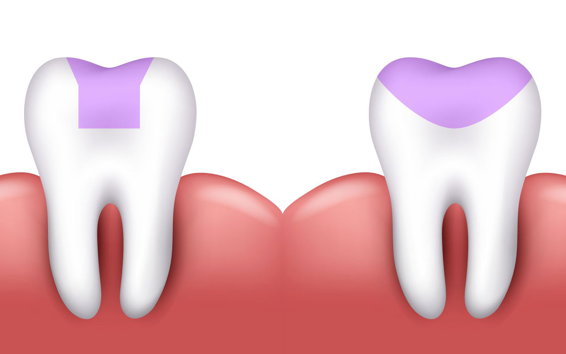 Dental Inlay and Onlays Chino - Your Chino Dentist