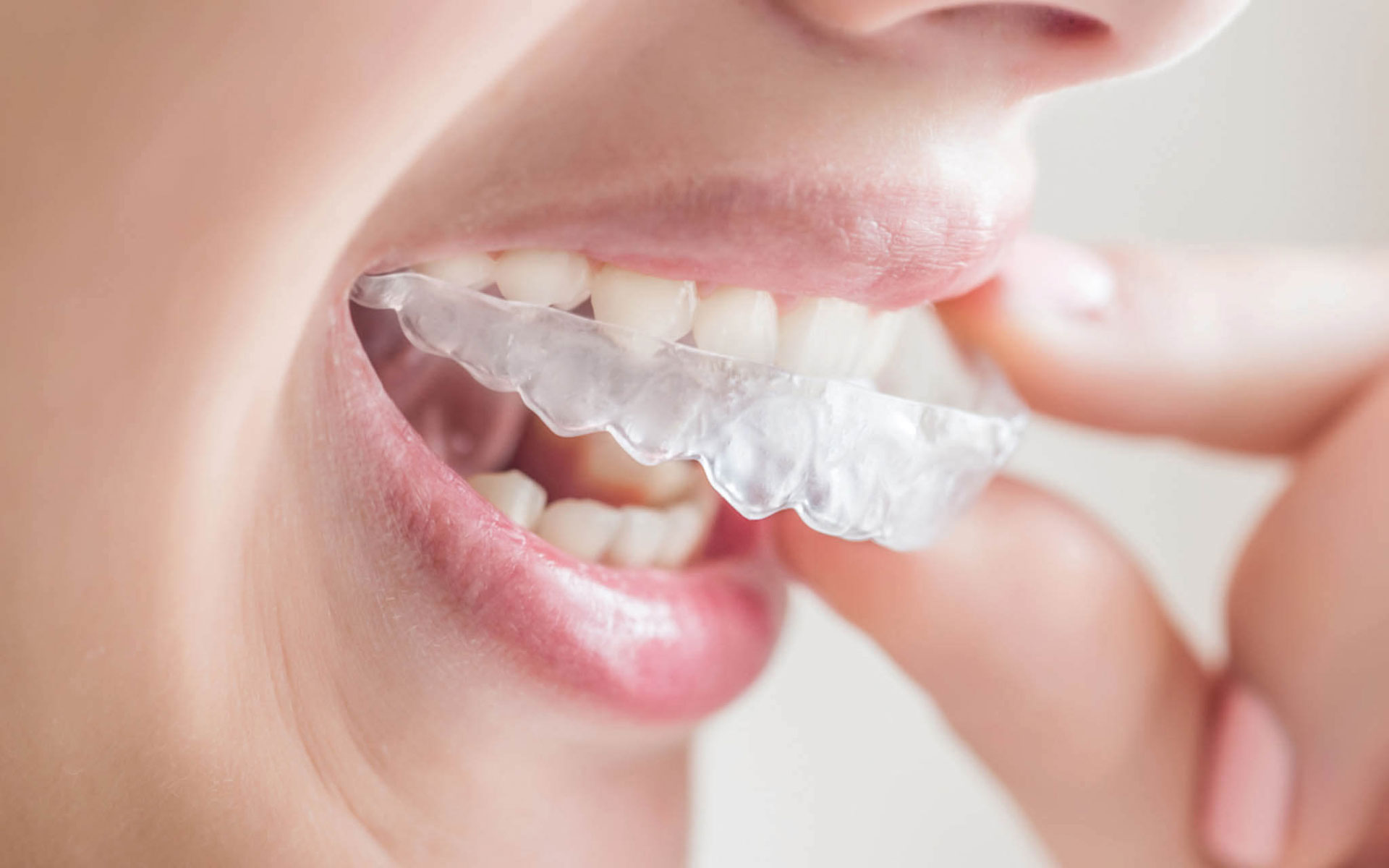 Invisalign Chino - Your Chino Dentist